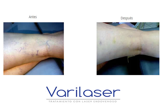 VARICES QUITO