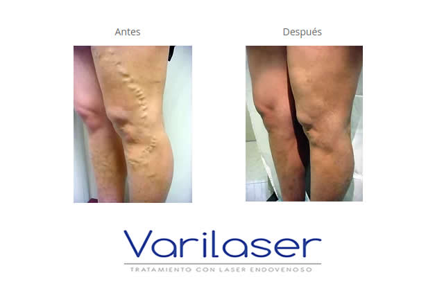 VARICES QUITO